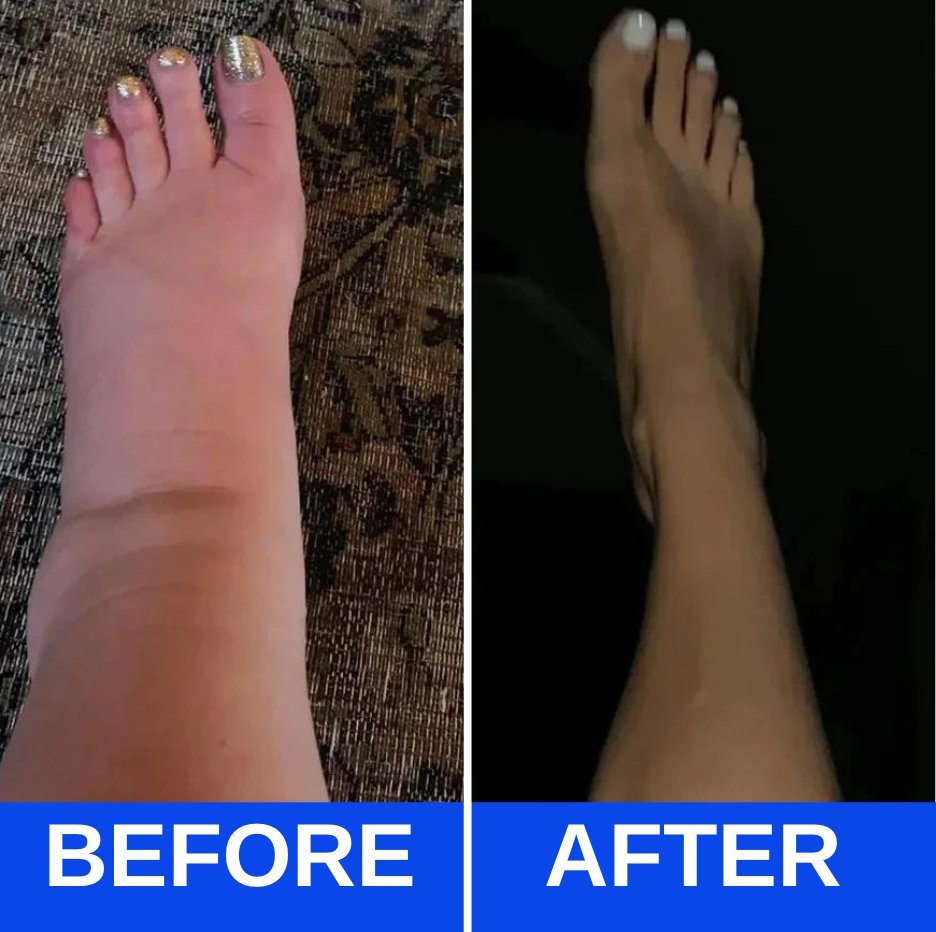 Before and after results showing reduced foot swelling and improved circulation using an EMS foot massager for pain relief and neuropathy treatment.