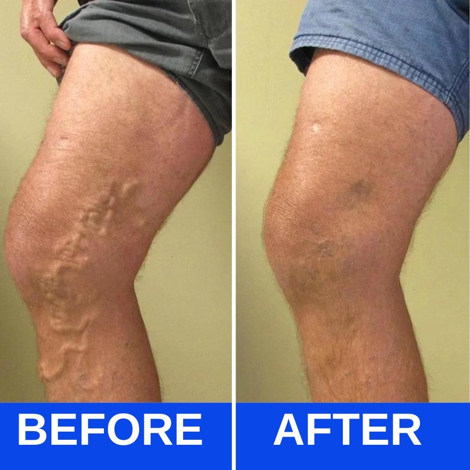 Before and after results showing reduced varicose veins and improved leg appearance using an EMS foot massager for neuropathy and foot pain relief.